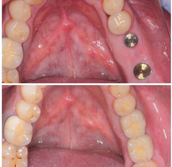 Можно ли ставить импланты сразу после удаления зубов